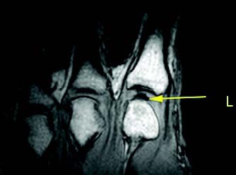 x-ray-knuckle-with-bubble x-ray-knuckle-with-bubble