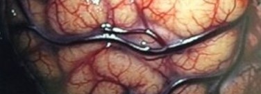 biology-archive-lighting-the-way-through-brain-surgery-1761