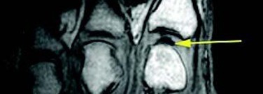 Life-science-archive-mri-scan-reveals-why-knuckles-crack-1761